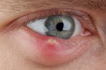 מה חשוב לדעת על טיפול בשעורה בעין
